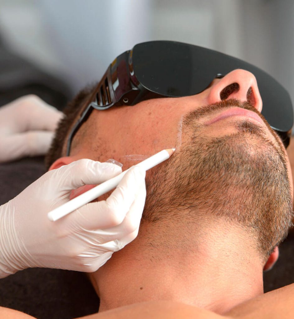 depilacion-laser-facial-en-malaga-1