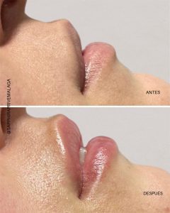 resultado antes después de la hidratación de labios con ácido hialurónico y multipunción en málaga