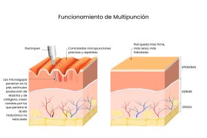 cómo funciona la multipunción, dermapen, electropen, hidratación de labios, estimulación de colágeno