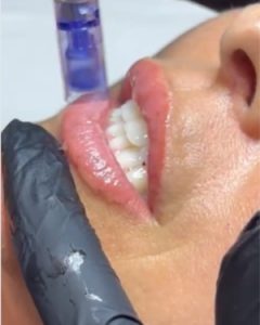 promoción de hidratación de labios con ácido hialurónico en málaga, tratamiento de labios con dermapen.