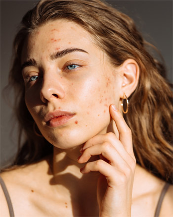 el mejor peeling facial en málaga, peeling despigmentante, peeling antimanchas, peeling para eliminar las marcas de acné