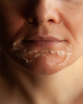 el mejor peeling facial en malaga, peeling facial de intensidad media, descamación de peeling facial