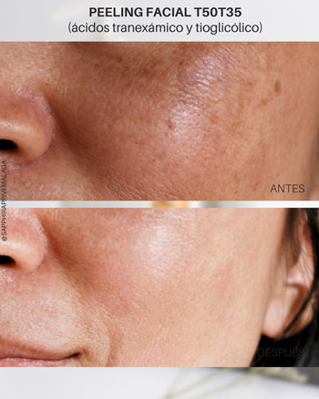el mejor peeling facial en malaga, resultado antes después de peeling antimanchas