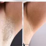 depilación láser diodo sin dolor, 2x1 en bonos depilación láser en málaga