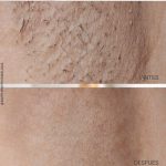 depilacion láser diodo en málaga, depilación sin dolor en málaga