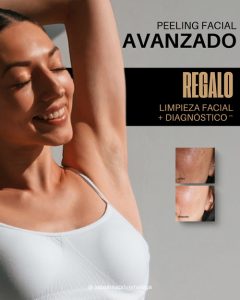 peeling facial en málaga, promoción peeling, peeling antimanchas, melasma