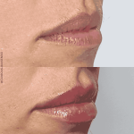 mejor médico estético en Málaga, DrRafael Tobías, Dra María Ramos, Dra MAri paz Ortigosa, Medicina estética, aumentar los labios, ácido hialurónico, relleno de labios, elegant lips, lip fillers.