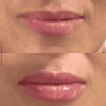mejor médico estético en Málaga, DrRafael Tobías, Dra María Ramos, Dra MAri paz Ortigosa, Medicina estética, aumentar los labios, ácido hialurónico, relleno de labios, elegant lips, lip fillers.