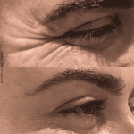 mejor médico estético en Málaga, Dra María Ramos, Dr Rafael Tobías, Dra Mari Paz Ortigosa, Medicina estética, eliminar arrugas, Arrugas de expresión, neuromoduladores, botox