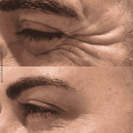 mejor médico estético en Málaga, Dra María Ramos, Dr Rafael Tobías, Dra Mari Paz Ortigosa, Medicina estética, eliminar arrugas, Arrugas de expresión, neuromoduladores, botox