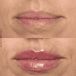 mejor médico estético en Málaga, DrRafael Tobías, Dra María Ramos, Dra MAri paz Ortigosa, Medicina estética, aumentar los labios, ácido hialurónico, relleno de labios, elegant lips, lip fillers.