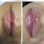 hidratación de labios en malaga resultado, antes después hidratación de labios en malaga, acido hialurónico en labios en málaga