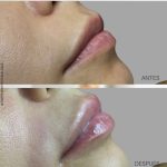 hidratación de labios en malaga resultado, antes después hidratación de labios en malaga, acido hialurónico en labios en málaga