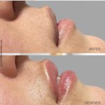 hidratación de labios en malaga resultado, acido hialuronico en labios resultado