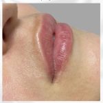 hidratación de labios en malaga resultado, antes después hidratación de labios en malaga, acido hialurónico en labios en málaga