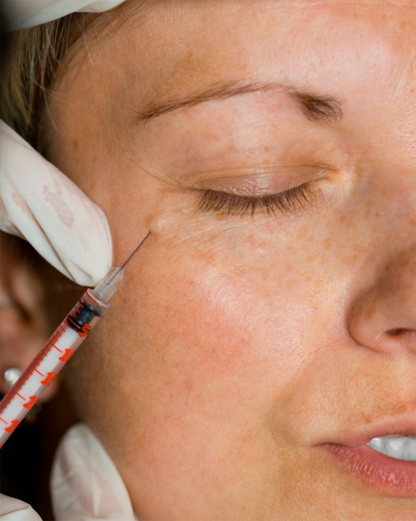 Eliminar-las-arrugas-de-expresion-en-Malaga​