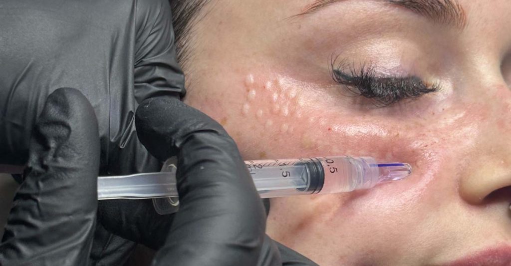 eliminar las ojeras en málaga en clinica alba asensio, eliminar las ojeras con vitaminas, nctf 135HA