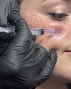 eliminar las ojeras en málaga con vitaminas NCTF 135HA, clinica estética en Málaga, médico estético en málaga, mesoterapia en málaga, vitaminas en málaga