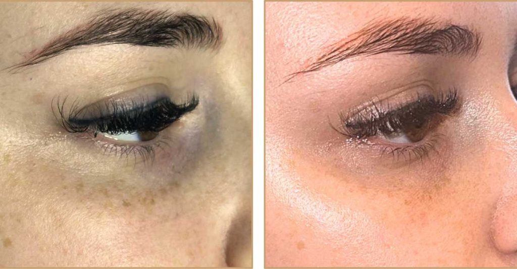 resultado antes despues de eliminar las ojeras en málaga con las vitaminas NCTF 135HA