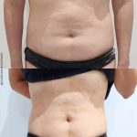 promoción corporal para eliminar la grasa localizada en málaga, eliminar la celulitis y tonificar el cuerpo. Combina tus tratamientos de cavitación, radiofrecuencia corporal, maderoterapia, vecuumfit, vacuumterapia, presoterapia, criolipolisisi y electroestimulación intensiva según tus necesidades. Complementa tus tratamientos corporales con terapias médicas como mesoterapia, inductores de colágeno y tratamiento de sobrepeso y obesidad con inyectables