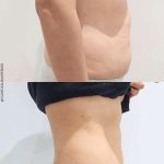 promoción corporal para eliminar la grasa localizada en málaga, eliminar la celulitis y tonificar el cuerpo. Combina tus tratamientos de cavitación, radiofrecuencia corporal, maderoterapia, vecuumfit, vacuumterapia, presoterapia, criolipolisisi y electroestimulación intensiva según tus necesidades. Complementa tus tratamientos corporales con terapias médicas como mesoterapia, inductores de colágeno y tratamiento de sobrepeso y obesidad con inyectables