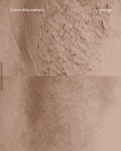 depilación láser diodo málaga, mejor depilación láser, depilación láser sin dolor, promoción de depilación láser en málaga, 2x1 en depilación láser, depilación láser corporal, depilación láser facial, clínica estética en málaga