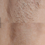 promoción depilación láser diodo triple onda en málaga, laser diodo triple onda, depilación láser sin dolor en málaga