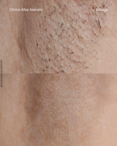 promoción depilación láser diodo triple onda en málaga, laser diodo triple onda, depilación láser sin dolor en málaga