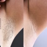 promoción depilación láser diodo triple onda en málaga, laser diodo triple onda, depilación láser sin dolor en málaga