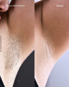 promoción depilación láser diodo triple onda en málaga, laser diodo triple onda, depilación láser sin dolor en málaga