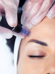 tratamiento de exosomas en málaga, el mejor tratamiento de medicina estética regenerativa, exosomas con dermapen. Multipunción con exosomas, promoción peeling + exosomas