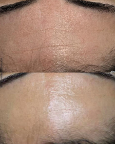 los mejores tratamientos faciales en málaga, clinica estetica en el limonar en málaga, tratamientos para novias, tratamientos de belleza en málaga